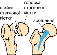 перелом кістки